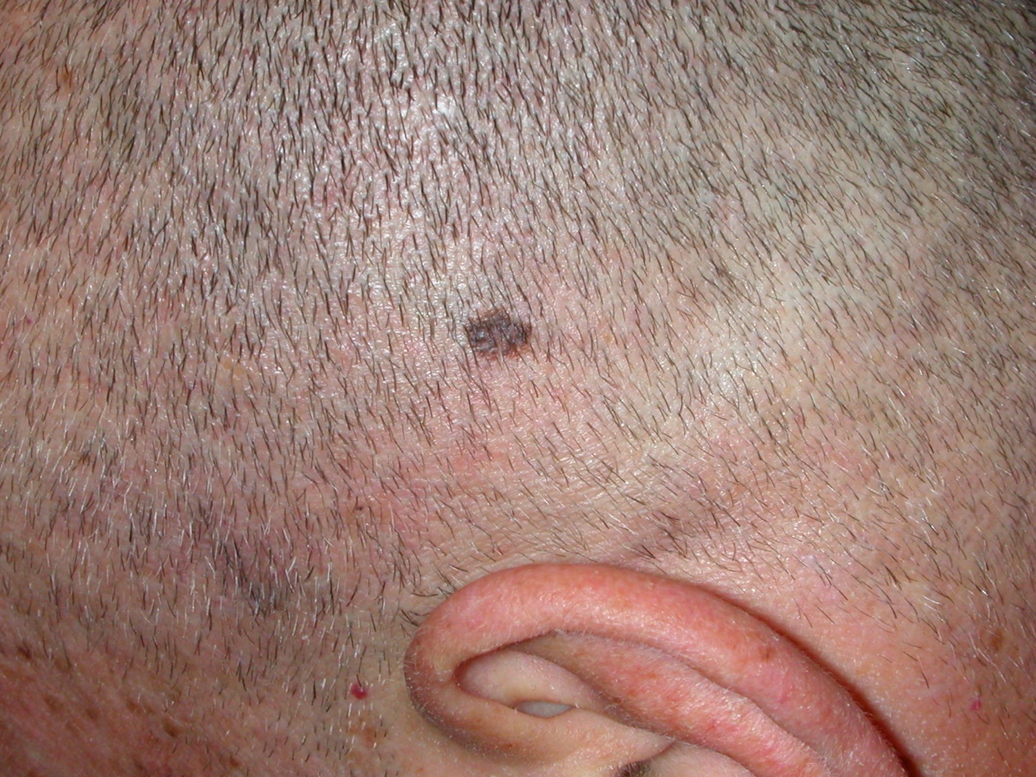 Stress And Bald Spots On The Scalp