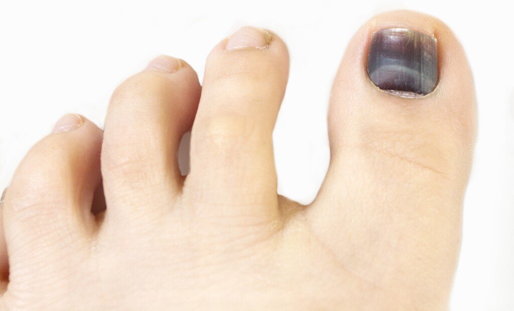 Toenail Subungual Hematoma Vs Melanoma Visible Differences Scary