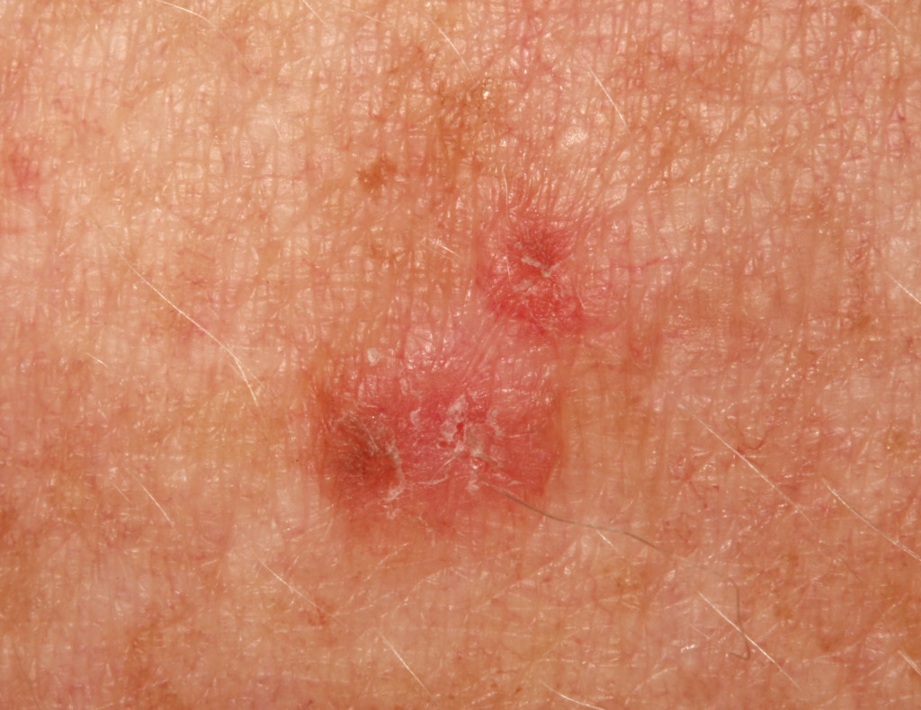Difference Between Actinic Keratosis And Seborrheic Keratosis Compare Images