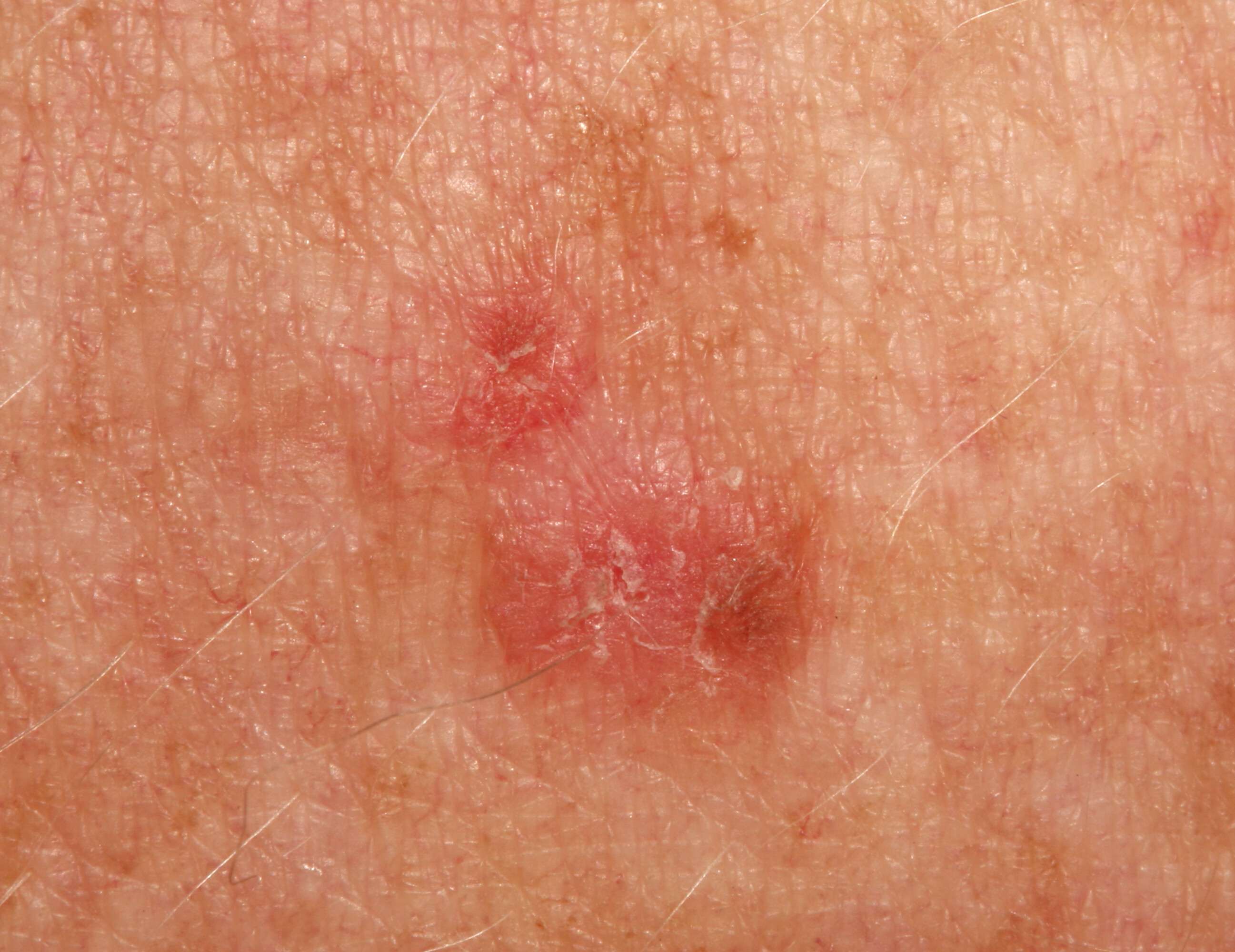 Actinic Keratosis Prevention with Retin A ? » Scary Symptoms