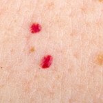 What Those Tiny Red Dots on Your Skin Might Mean