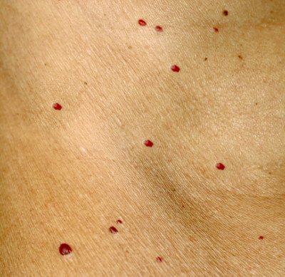 pinpoint red spots on the skin pictures