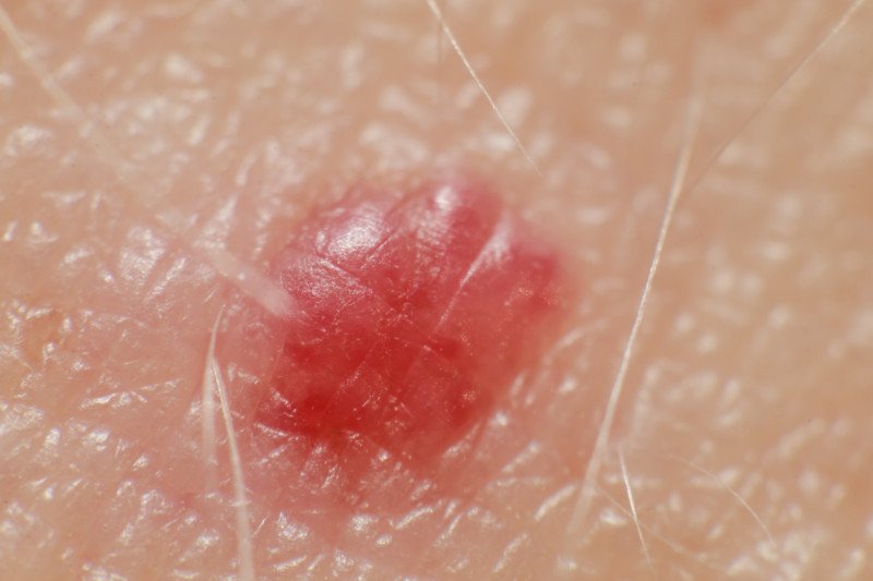 small red pinpoint raised spot on skin