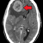 What Is the “Best” Kind of Brain Tumor to Have?