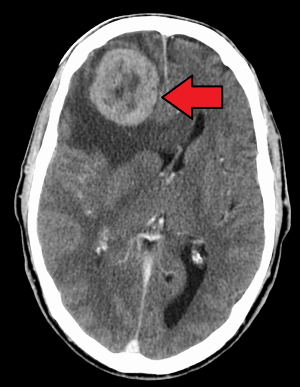 Brain Tumor Headache vs. Normal Headaches » Scary Symptoms