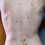 Are Most Funny Looking Moles Normal & Benign?
