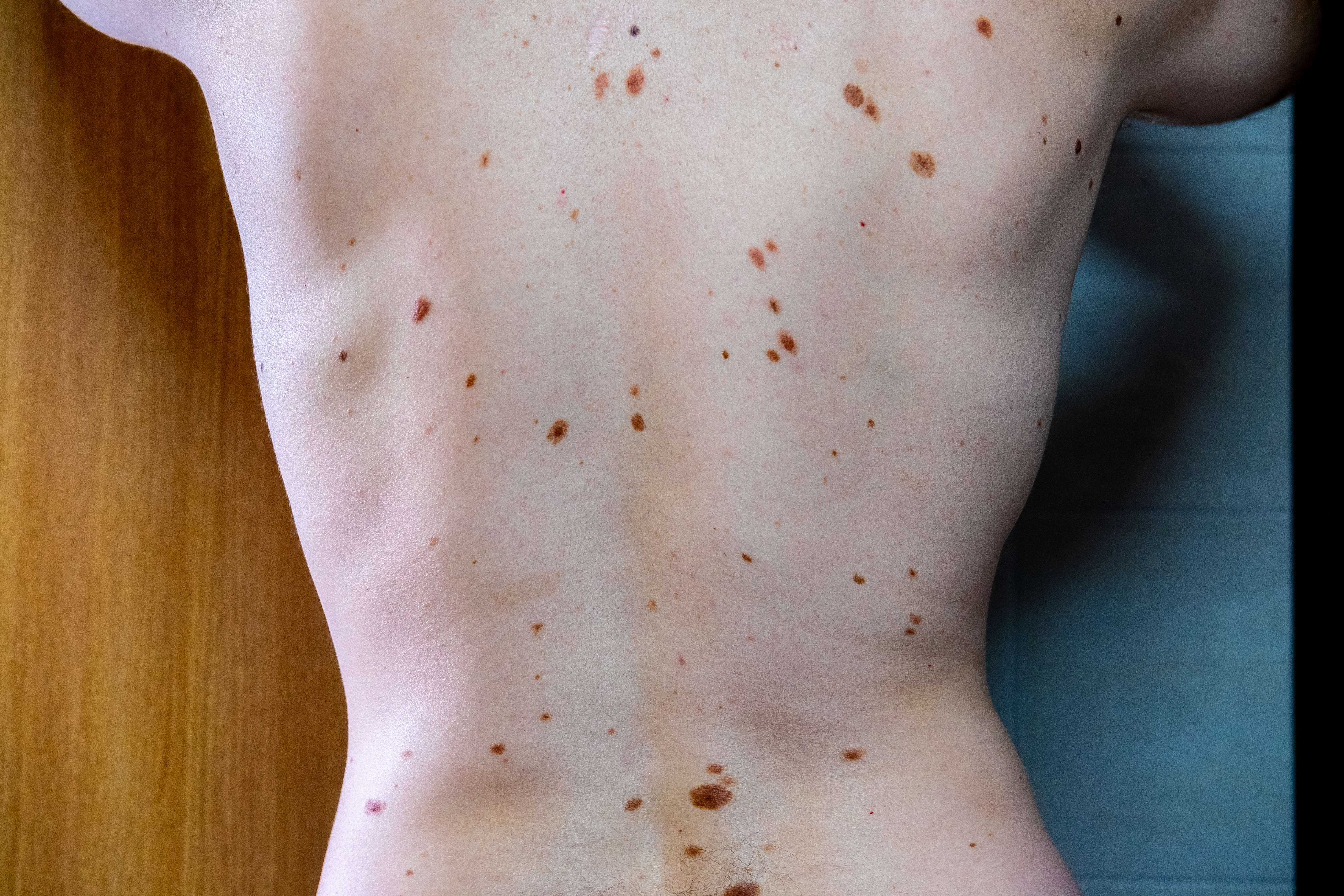 How Are Hundreds of Moles Removed All At Once?