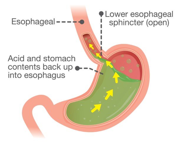 How Long It Takes GERD to Turn into Esophageal Cancer? » Scary Symptoms