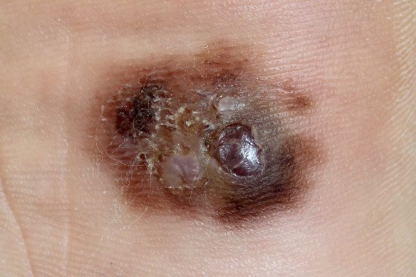 what-does-precancerous-or-atypical-mole-mean-scary-symptoms