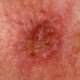 Actinic Keratosis Appearance Vs. Squamous Cell Carcinoma » Scary Symptoms