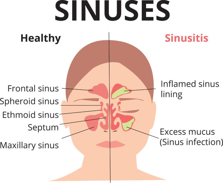 Sphenoid Sinusitis Headache Symptoms vs. Aneurysm Headache » Scary Symptoms
