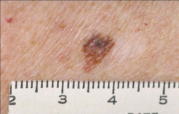 Melanoma Skin Cancer: When Changing Moles Are Benign » Scary Symptoms