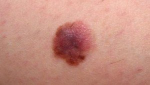 Melanoma Red 3 300x171 