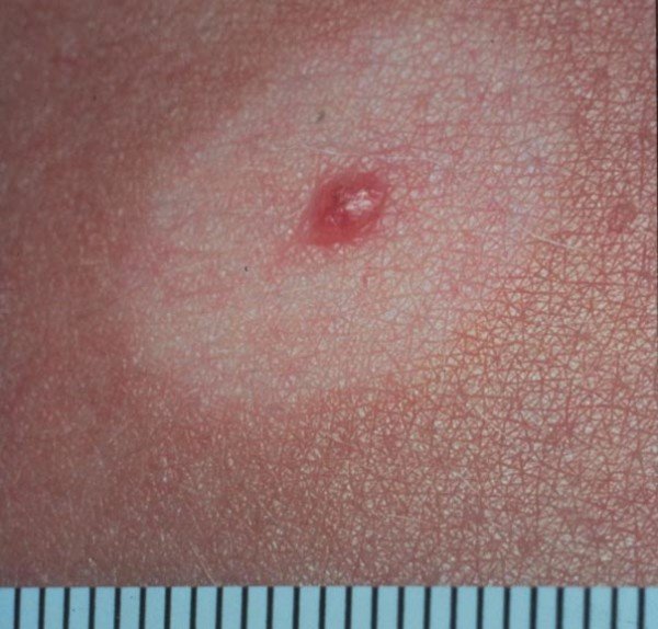 Fading Moles Melanoma Or Could This Be Something Else Besides Skin   Mole Halo Leonard C. Sperling MD PD.  600x574 