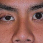 What Is Ptosis and Miosis?