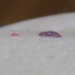 How Common Are Grey Moles? » Scary Symptoms