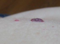 Are Purple Moles Normal Or Possible Cancer? » Scary Symptoms