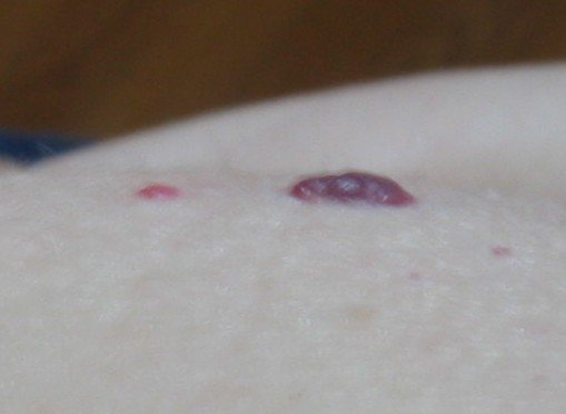 Purple my scar turn why did A Healing