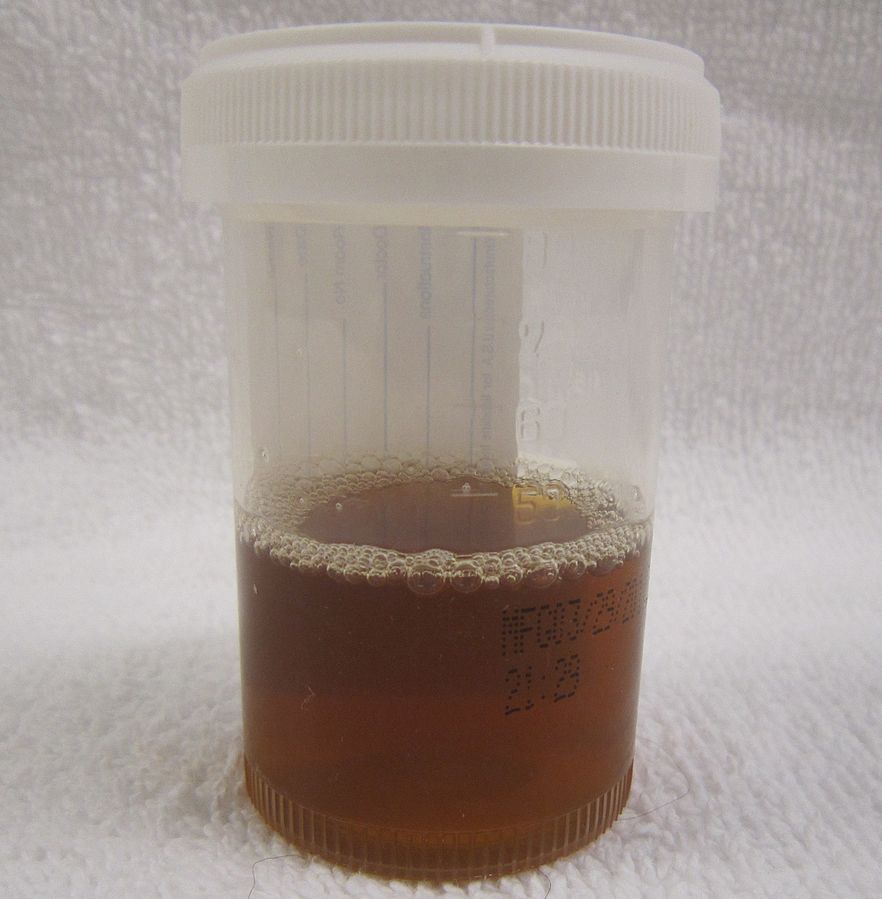 Dark Brown Urine Pictures at Thomas Hooper blog