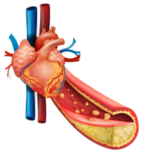 How to Make Diet Reverse Soft Plaque Buildup in Your Heart
