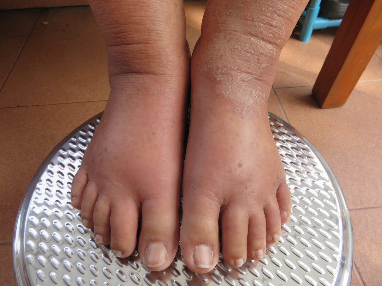 Ankle Swelling in the Elderly Causes & Solutions » Scary Symptoms