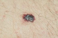 Malignant Melanoma vs. Benign: The Difference » Scary Symptoms