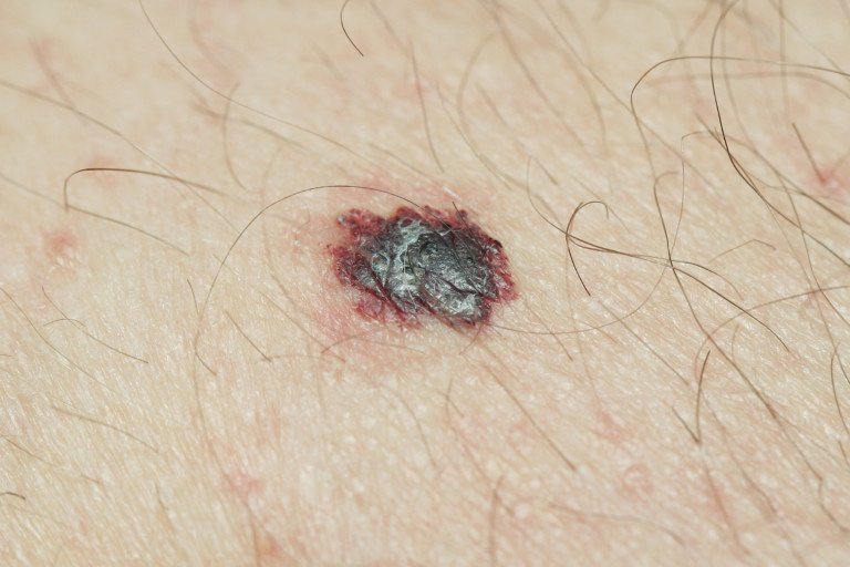 Is A Malignant Melanoma Different Than Just “melanoma” Scary Symptoms