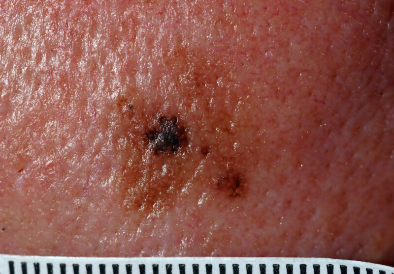 When an Itching Mole Begins Bothering You » Scary Symptoms