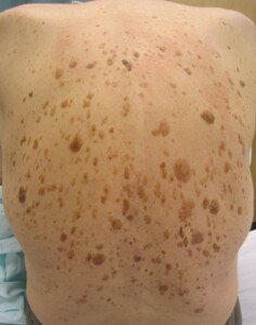 Can Seborrheic Keratosis Turn into Skin Cancer?
