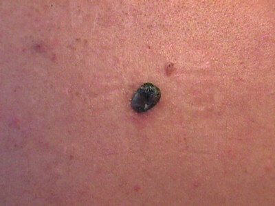 itching mole on breast itching mole on breast