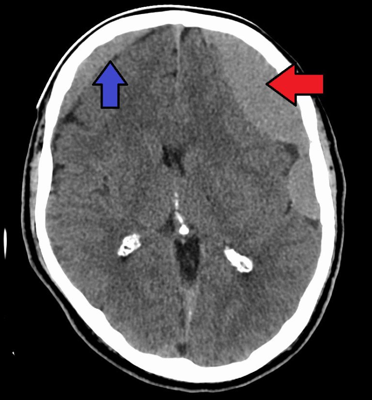 Normal CT Scan After Hitting Head: Brain Bleed Can Still Occur » Scary