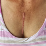 Symptoms You Can Expect After Coronary Bypass Surgery