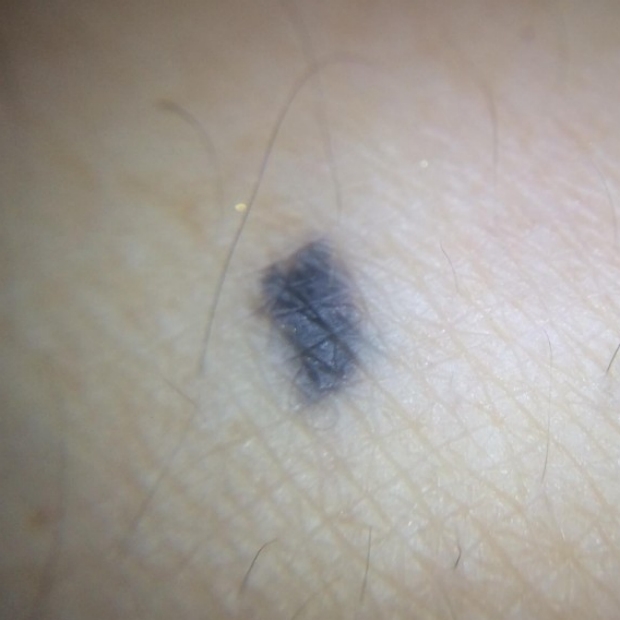 Does a Blue Mole Mean Possible Melanoma?