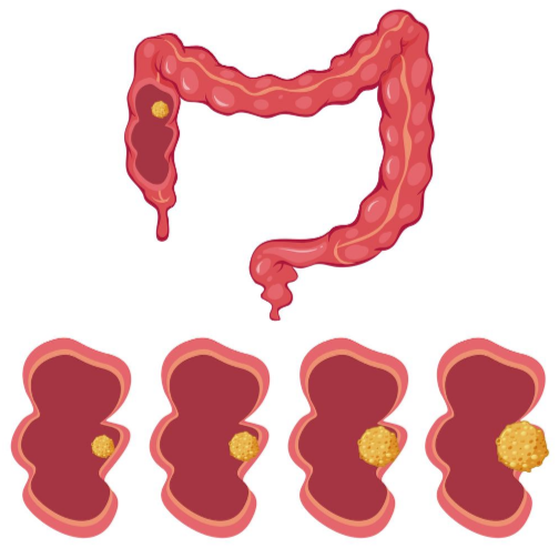 Causes Of Thin Narrow Stools Besides Colon Cancer Scary Symptoms