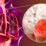 How Long Can Esophageal Cancer Go Undetected?