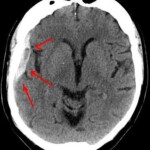 BRAIN BLEED from Concussion Can Mean Subdural Hematoma