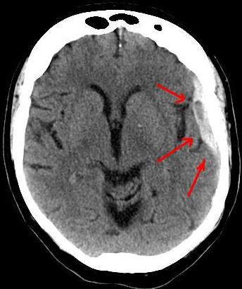 BRAIN BLEED from Concussion Can Mean Subdural Hematoma