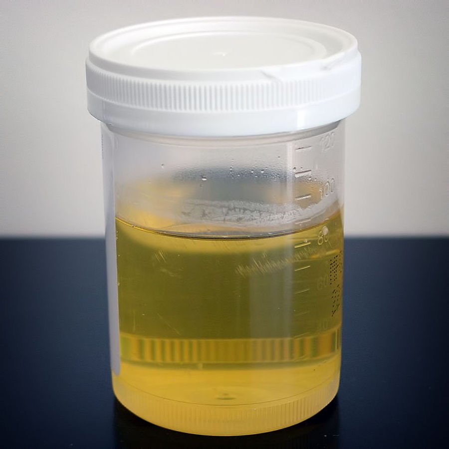 How Healthy Are You? How to Check Your Urine