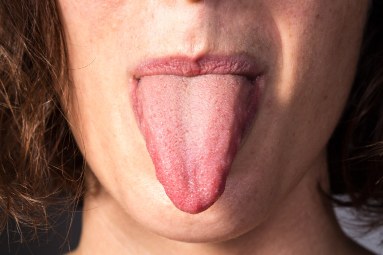 Burning Tongue 9 Causes, One LifeThreatening » Scary Symptoms