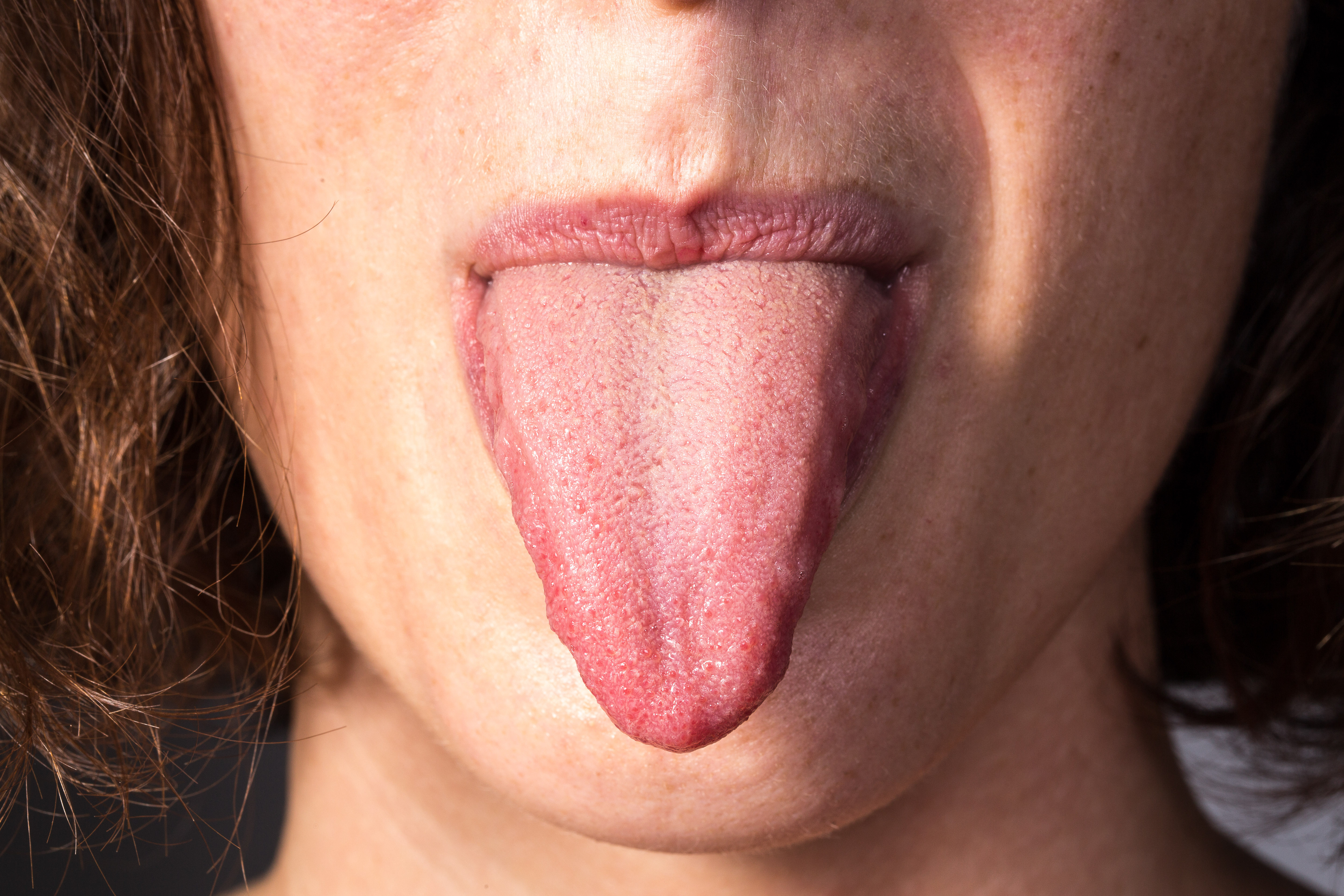 Burning Tongue 9 Causes, One LifeThreatening » Scary