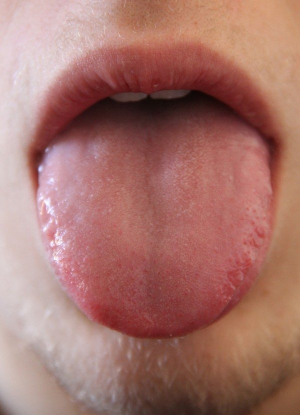 Sore Tongue The Many Causes and Solutions » Scary Symptoms