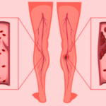 How Does Surgery Cause a DVT?