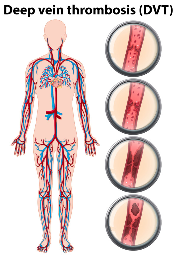 How Long Does It Take DVT to Form from Bed Rest? » Scary Symptoms
