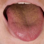 Can Gerd Cause a Yellow Orange Coated Tongue?