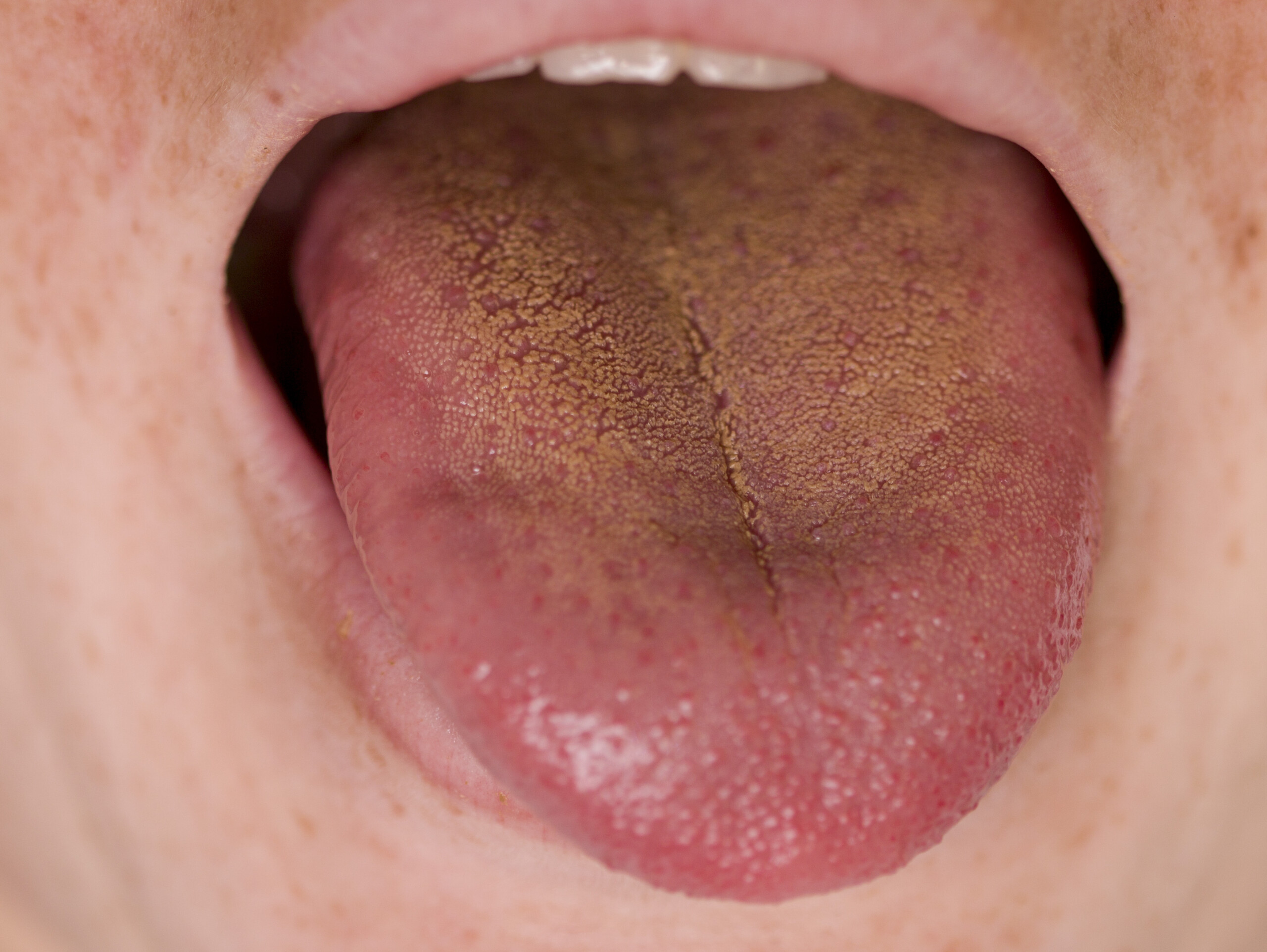 Can Gerd Cause a Yellow Orange Coated Tongue?