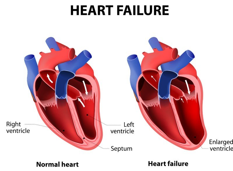 Does Ejection Fraction Decrease with Acute Heart Failure? » Scary Symptoms