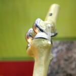 Gold Standard for Diagnosing Failed Knee Replacement