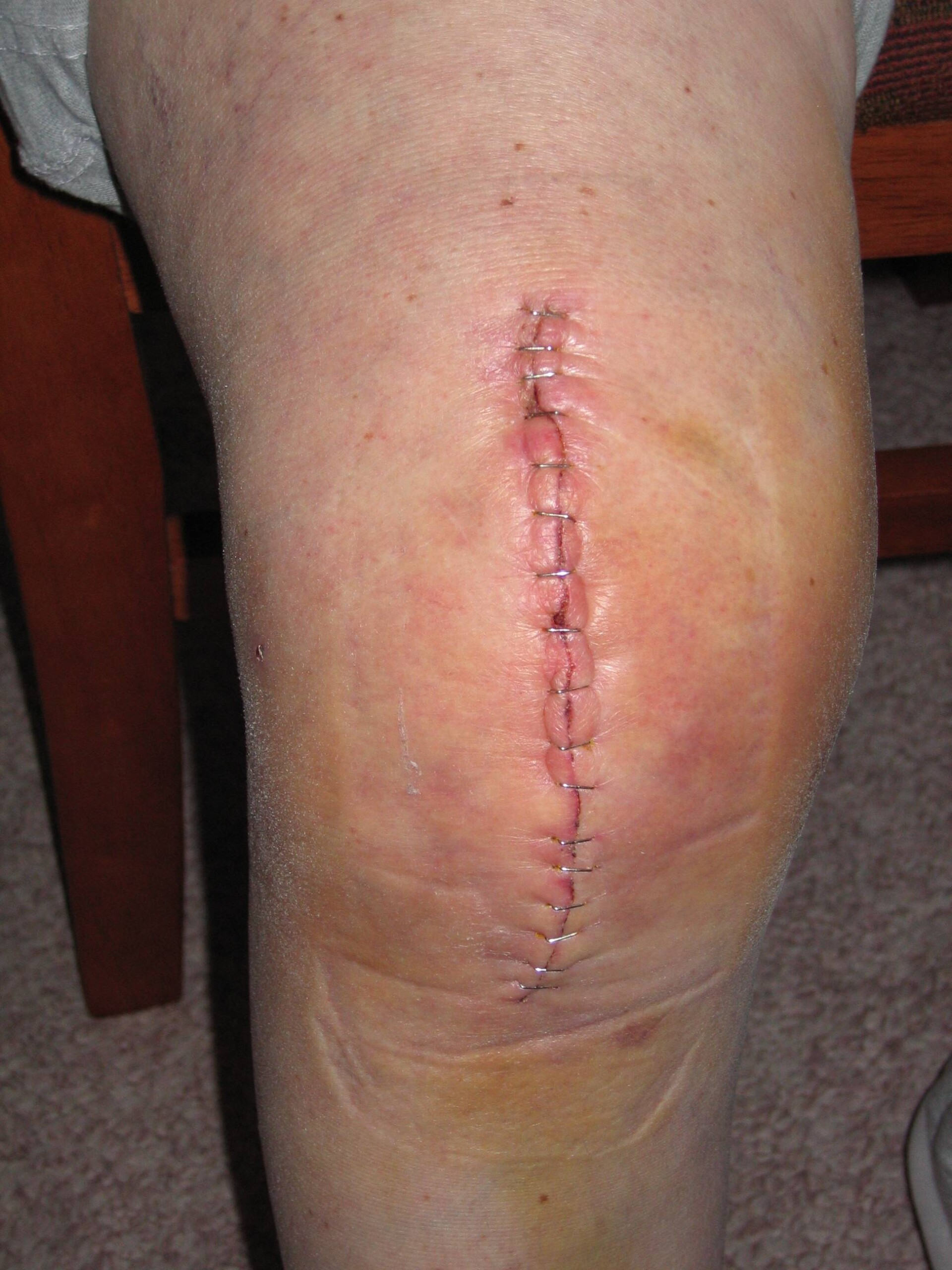 Is Leg Swelling After Knee Replacement Always DVT?