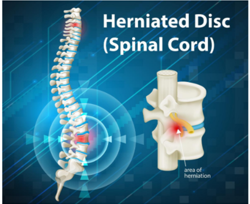 Can Foot Numbness from a Herniated Disc Be Permanent? » Scary Symptoms