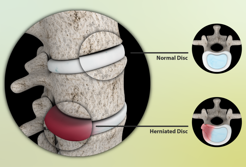 When Is Surgery Needed For A Lumbar Herniated Disc Scary Symptoms